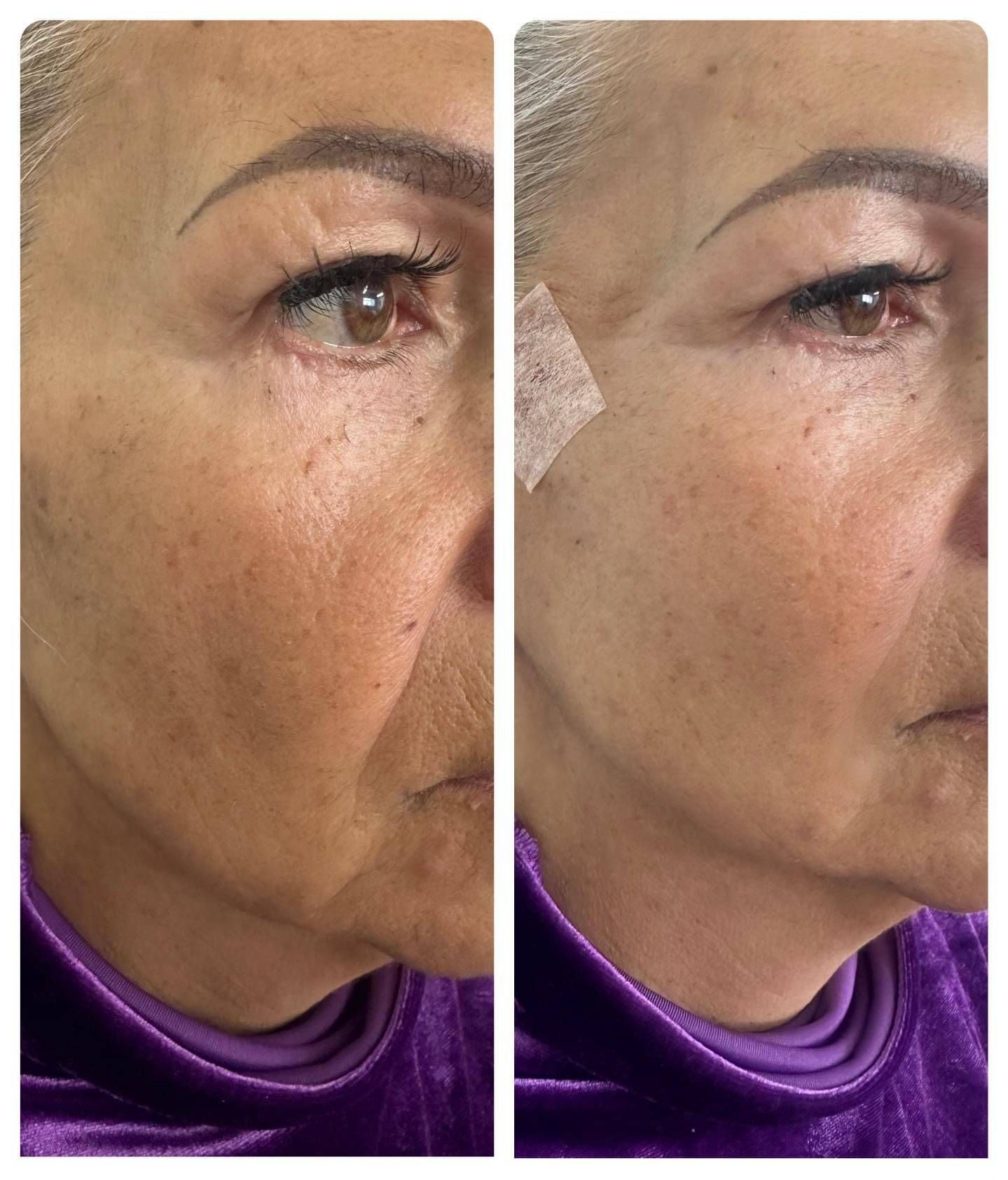 Sunekos Eye treatment - Before and After
