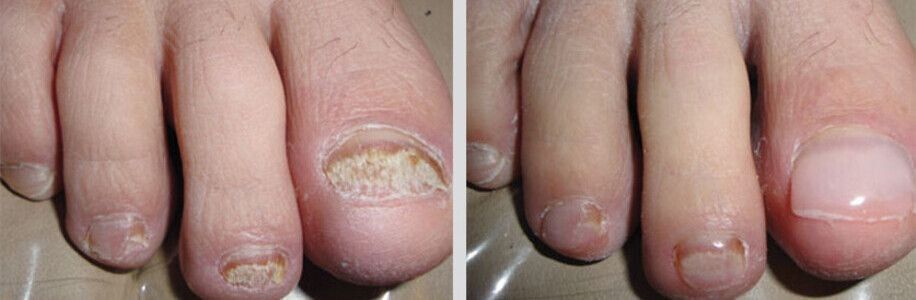 Cosmetic Nail Restoration | Foot Foundation | New Zealand