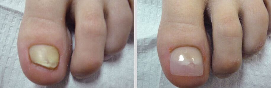 Cosmetic Nail Restoration | Foot Foundation | New Zealand