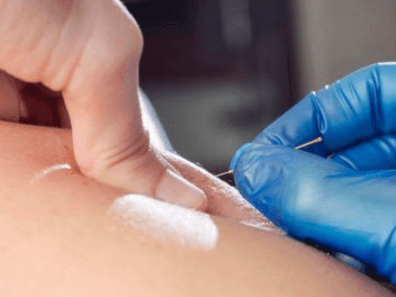 Dry Needling at Foot Foundation