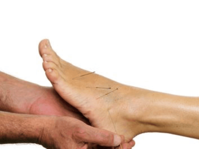 Dry Needling at Foot Foundation