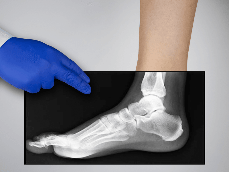 Heel Pain education and Diagnosis Foot Foundation