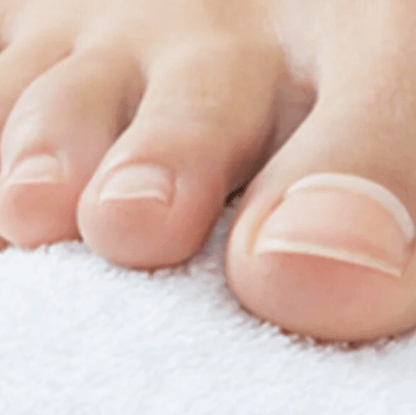 Onyfix Nail Bracing