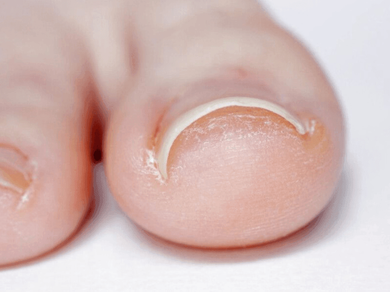 Close-up of an ingrown toenail curving into skin.