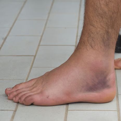 Chronic Ankle Instability Treatment at Foot and Ankle Rehabilitation