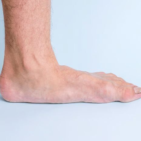 Flat Feet Treatment at Foot and Ankle Rehabilitation