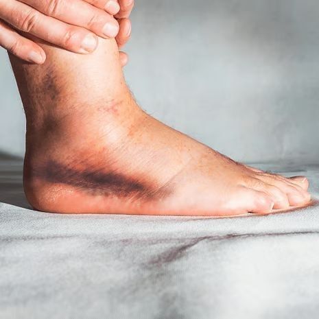 Posterior Tibial Tendon Dysfunction Treatment at Foot and Ankle Rehabilitation