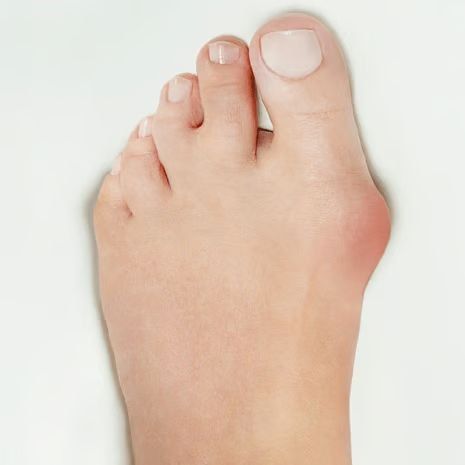 Bunion Treatment at Foot and Ankle Rehabilitation