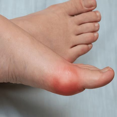 Sesamoiditis Treatment at Foot and Ankle Rehabilitation