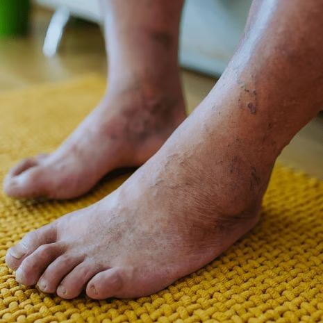 Diabetic Foot Complications Treatment at Foot and Ankle Rehabilitation
