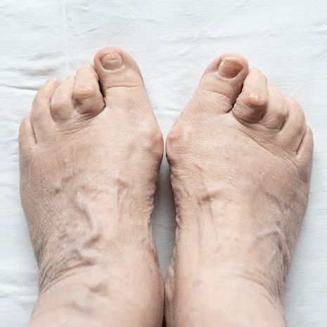 Midfoot Overuse treatment at Foot and Ankle Rehabilitation