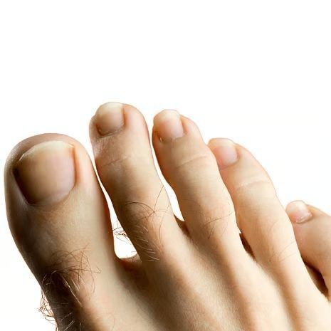 Mallet toes treatment at Foot and Ankle Rehabilitation