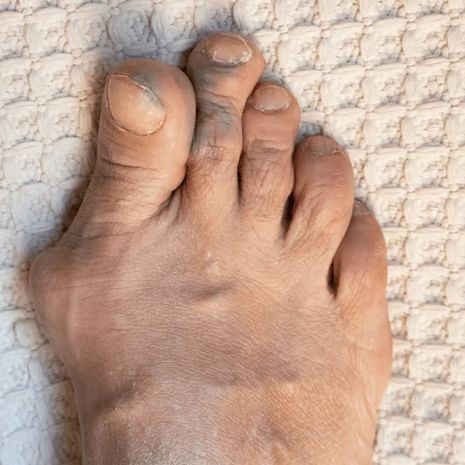 Overlapping toes treatment at Foot and Ankle Rehabilitation
