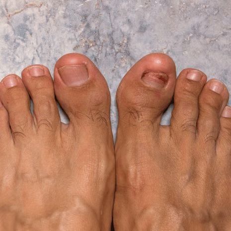 Turf toe treatment at Foot and Ankle Rehabilitation
