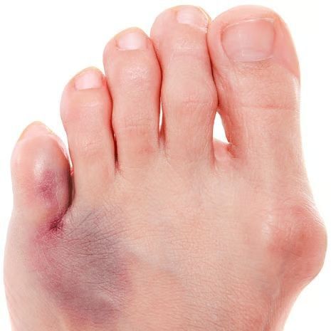 Toe Fractures & Trauma treatment at Foot and Ankle Rehabilitation