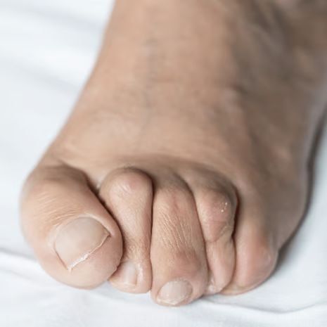 Plantar Plate Injury treatment at Foot and Ankle Rehabilitation