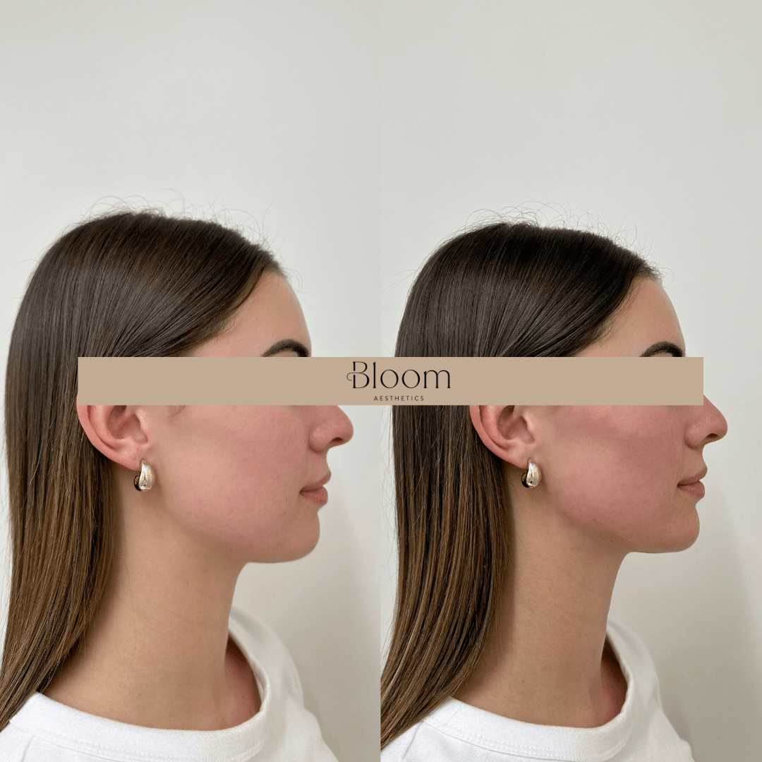 Dermal filler before and after comparison of a Bloom Aesthetics client