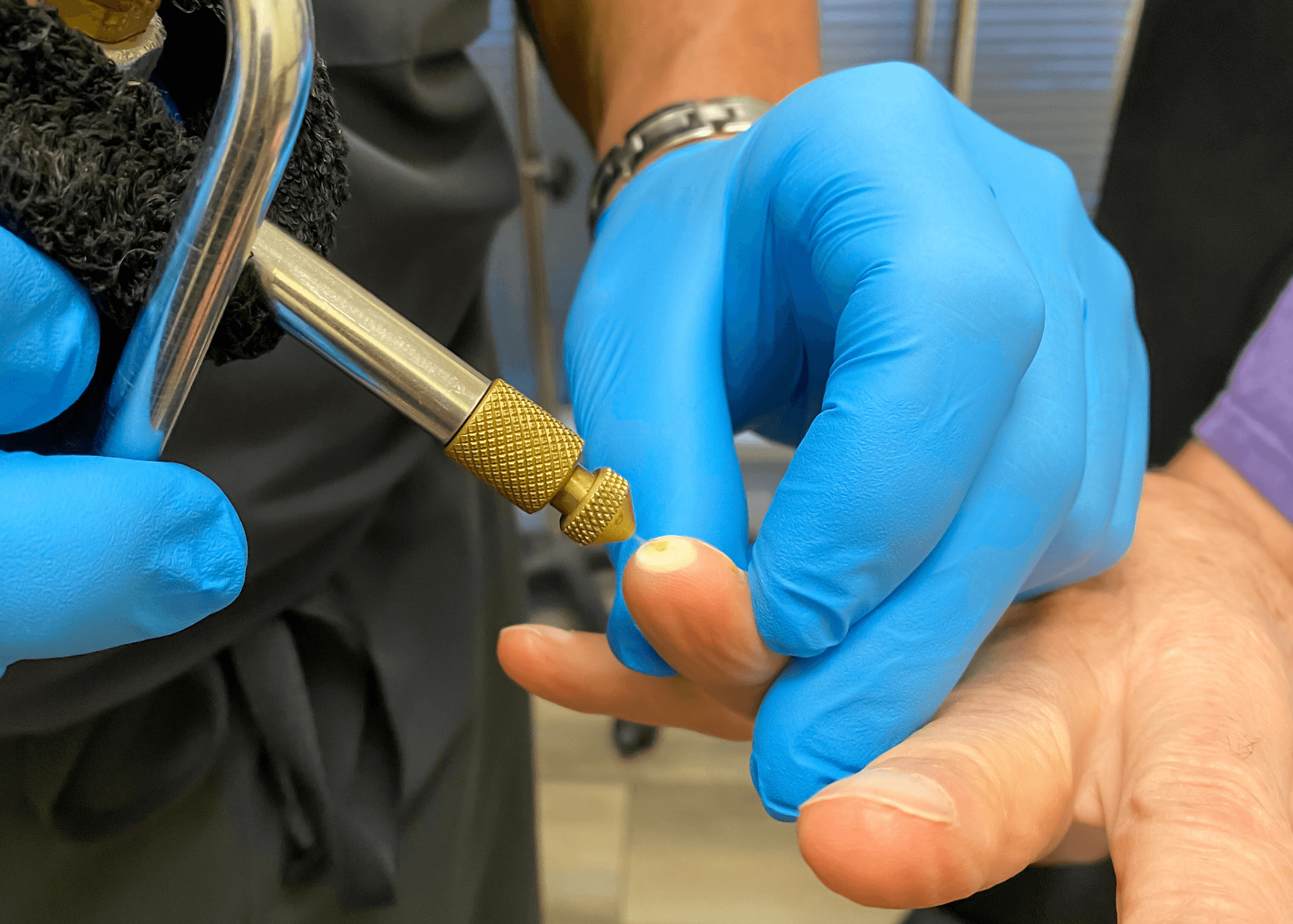 Liquid Nitrogen Treatment in Hawkes Bay