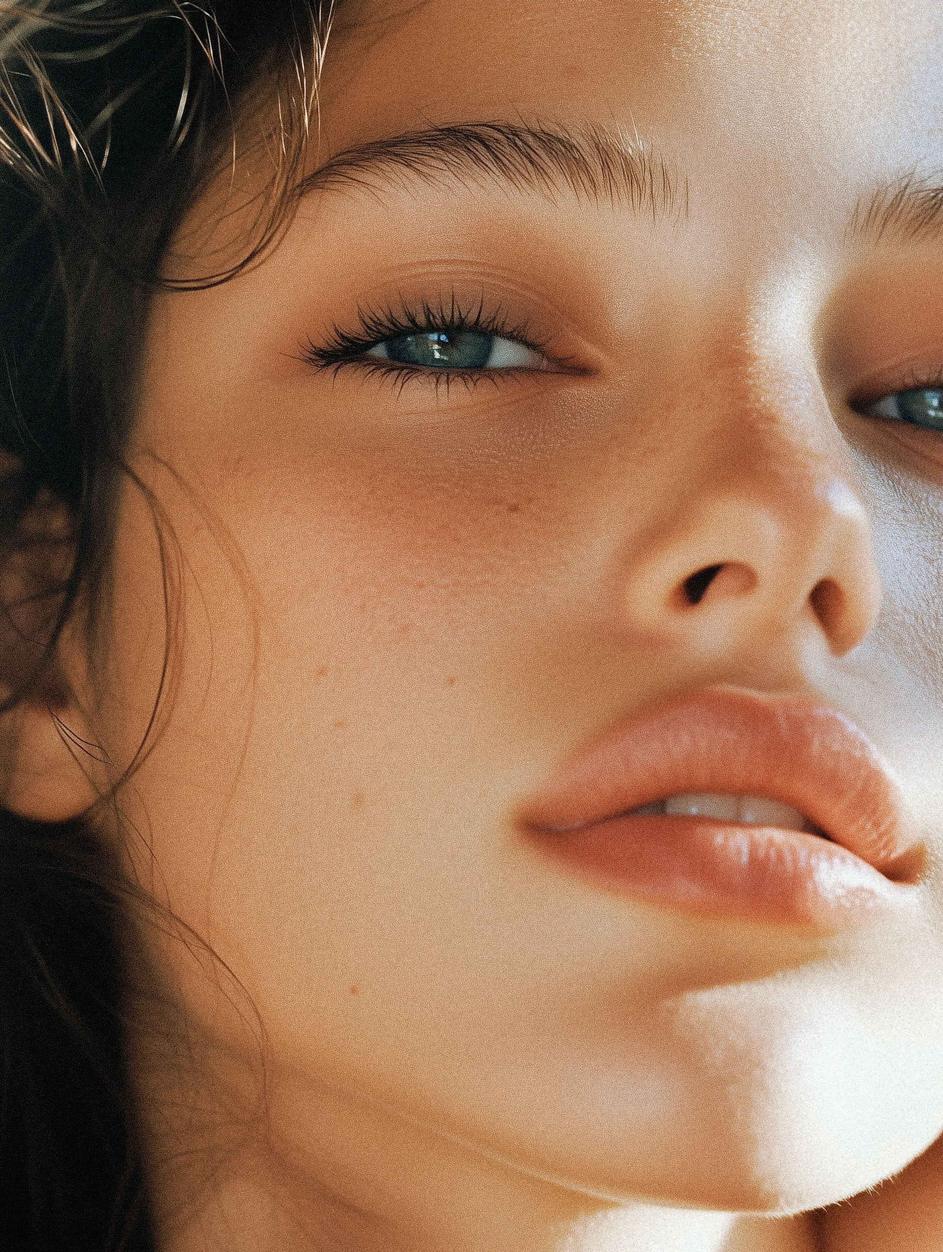 results of dermal filler restoring volume and facial balance