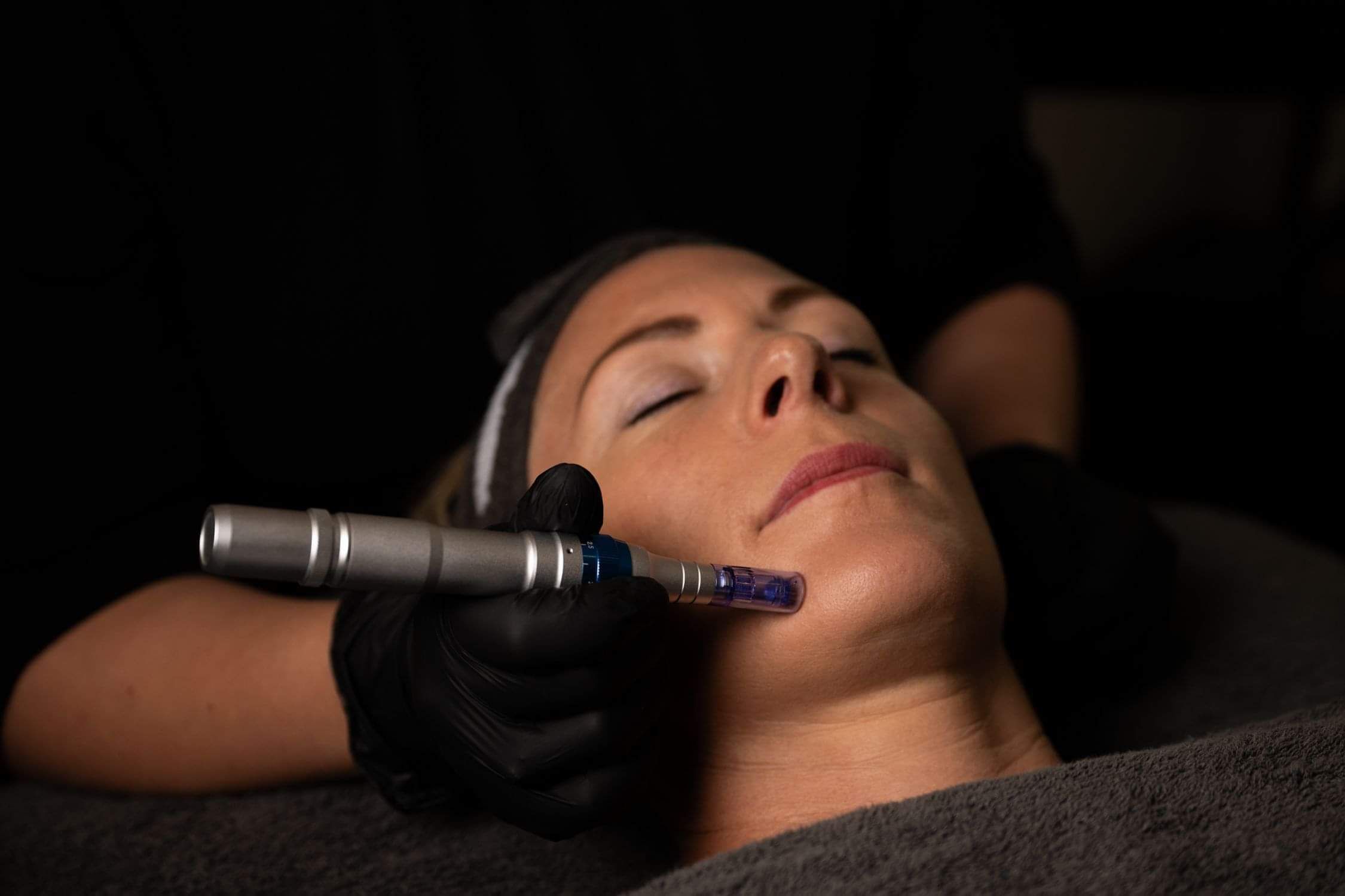 Kinloch Beauty Room Microneedling